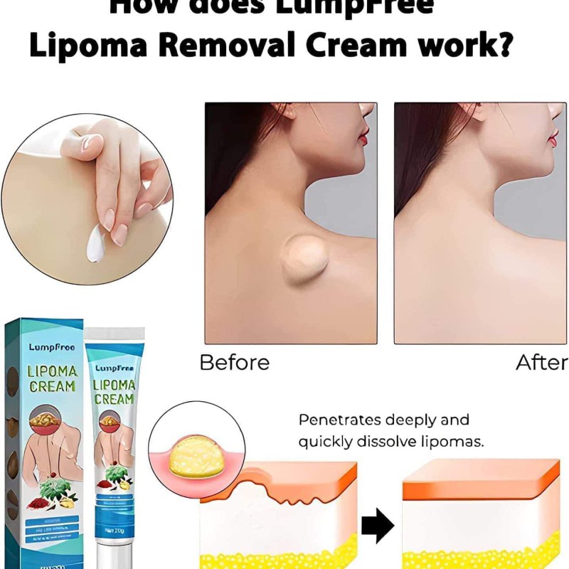 ৩ পিছ LIPOMA CREAM - অপারেশন ছাড়া আজই আপনার লাইপোমা ভালো করুন